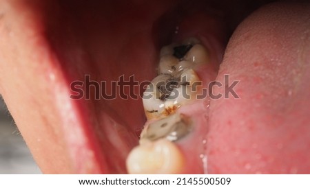 Decayed tooth root canal treatment. Tooth or teeth decay of lower molar. Restoration with a composite filling. Adult caries. bad teeth. Dental temporary restorative material. Dental concept. close up. Royalty-Free Stock Photo #2145500509