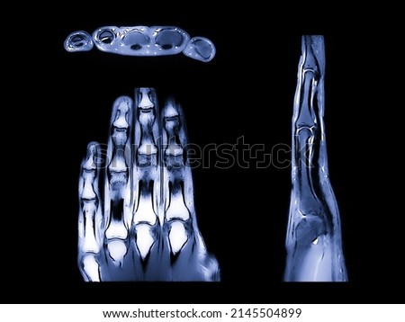 MRI X-ray image of a hand from various angles, with bones, muscle and tissue showing. Real MRI of a human hand.