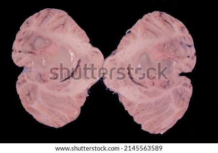 Human cerebellum showing two large cysts of liquefactive necrosis. In the brain, this type of necrosis can appear in bacterial infections or by the organization of an old cerebral infarction. Royalty-Free Stock Photo #2145563589