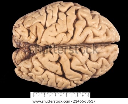 Gross anatomy of the dorsal surface of a human brain (fixed in formalin) showing a severe cortical atrophy with enlarged sulci and reduced giri, as can be seen in Alzheimer disease or senile brain Royalty-Free Stock Photo #2145563617