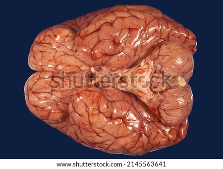 Gross anatomy of the dorsal surface of a human brain showing meningeal congestion, cerebral edema with enlarged sulci and bilateral atrophy of frontal lobe. Royalty-Free Stock Photo #2145563641