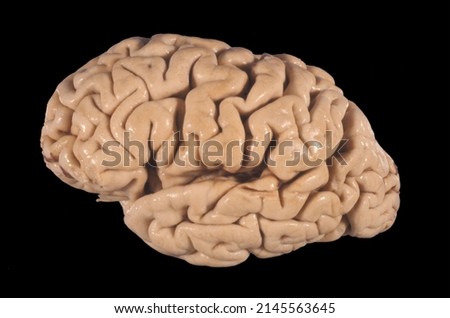 Gross anatomy of the lateral surface of a human brain (fixed in formalin) showing a severe cortical atrophy with enlarged sulci and reduced giri, as can be seen in Alzheimer disease or senile brain Royalty-Free Stock Photo #2145563645