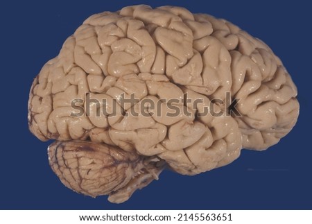 Gross anatomy of the lateral surface of a human brain showing a severe cortical atrophy with enlarged sulci and reduced giri. This aspect can be seen in Alzheimer diasease or senile brain. Royalty-Free Stock Photo #2145563651