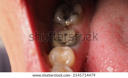 Decayed tooth root canal treatment. Tooth or teeth decay of lower molar. Restoration with a composite filling. Adult caries. bad teeth. Dental temporary restorative material. Dental concept. close up. Royalty-Free Stock Photo #2145714479