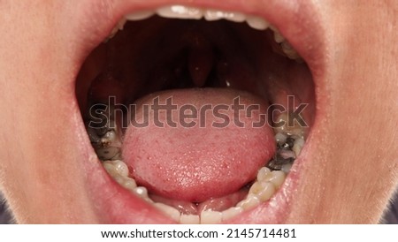 Decayed tooth root canal treatment. Tooth or teeth decay of lower molar. Restoration with a composite filling. Adult caries. bad teeth. Dental temporary restorative material. Dental concept. close up. Royalty-Free Stock Photo #2145714481