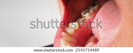 Decayed tooth root canal treatment. Tooth or teeth decay of lower molar. Restoration with a composite filling. Adult caries. bad teeth. Dental temporary restorative material. Dental concept. close up. Royalty-Free Stock Photo #2145714489