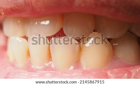 Decayed tooth root canal treatment. Tooth or teeth decay of lower molar. Restoration with a composite filling. Adult caries. bad teeth. Dental temporary restorative material. Dental concept. close up. Royalty-Free Stock Photo #2145867915