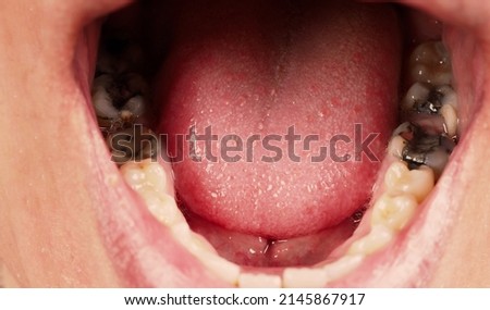 Decayed tooth root canal treatment. Tooth or teeth decay of lower molar. Restoration with a composite filling. Adult caries. bad teeth. Dental temporary restorative material. Dental concept. close up. Royalty-Free Stock Photo #2145867917