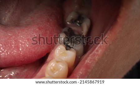 Decayed tooth root canal treatment. Tooth or teeth decay of lower molar. Restoration with a composite filling. Adult caries. bad teeth. Dental temporary restorative material. Dental concept. close up. Royalty-Free Stock Photo #2145867919