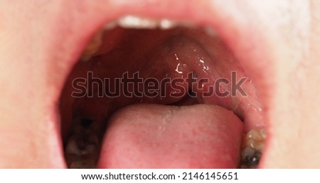 Decayed tooth root canal treatment. Tooth or teeth decay of lower molar. Restoration with a composite filling. Adult caries. bad teeth. Dental temporary restorative material. Dental concept. close up. Royalty-Free Stock Photo #2146145651