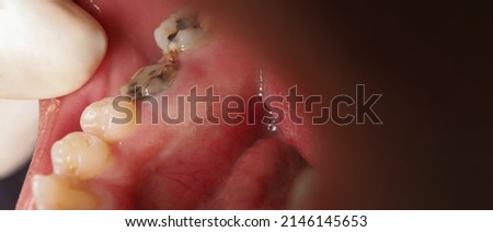 Decayed tooth root canal treatment. Tooth or teeth decay of lower molar. Restoration with a composite filling. Adult caries. bad teeth. Dental temporary restorative material. Dental concept. close up. Royalty-Free Stock Photo #2146145653