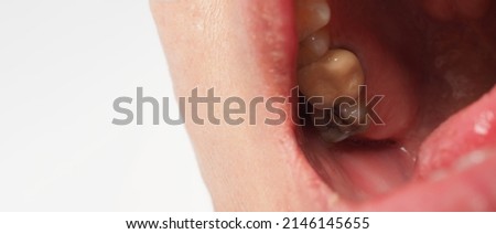 Decayed tooth root canal treatment. Tooth or teeth decay of lower molar. Restoration with a composite filling. Adult caries. bad teeth. Dental temporary restorative material. Dental concept. close up. Royalty-Free Stock Photo #2146145655