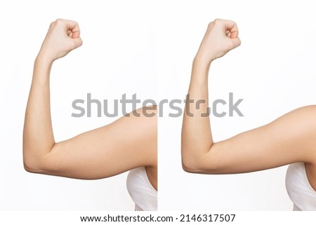 Two shots of a young woman with excess fat on her arm and toned arm before and after losing weight isolated on a white background. Result of diet, liposuction, training. Plastic surgery concept Royalty-Free Stock Photo #2146317507