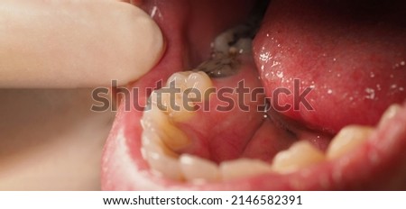 Decayed tooth root canal treatment. Tooth or teeth decay of lower molar. Restoration with a composite filling. Adult caries. bad teeth. Dental temporary restorative material. Dental concept. close up. Royalty-Free Stock Photo #2146582391