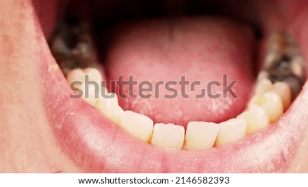 Decayed tooth root canal treatment. Tooth or teeth decay of lower molar. Restoration with a composite filling. Adult caries. bad teeth. Dental temporary restorative material. Dental concept. close up. Royalty-Free Stock Photo #2146582393
