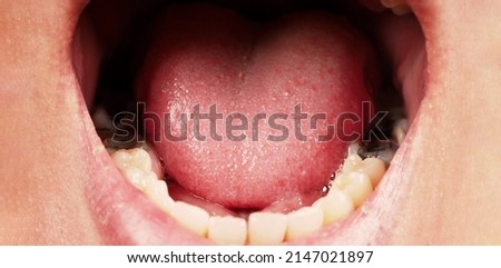 Decayed tooth root canal treatment. Tooth or teeth decay of lower molar. Restoration with a composite filling. Adult caries. bad teeth. Dental temporary restorative material. Dental concept. close up. Royalty-Free Stock Photo #2147021897