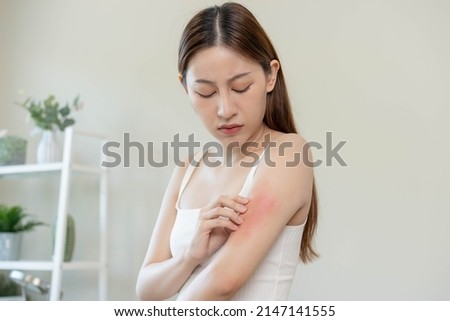 Dermatology, asian young woman, girl allergy, allergic reaction from atopic, insect bites on her arm, hand in scratching itchy, itch red spot or rash of skin. Healthcare, treatment of beauty. Royalty-Free Stock Photo #2147141555