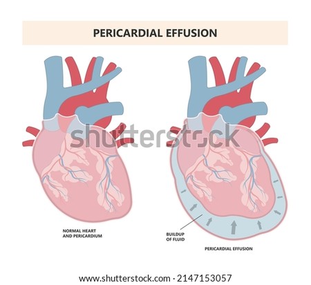 Heart attack acute chest pain injury difficulty breathing fat pads trauma fever shock viral bacterial fungal rate mRNA COVID-19 muscle dyspnea arrest unstable angina X-RAY diagnose Lupus virus cancer Royalty-Free Stock Photo #2147153057