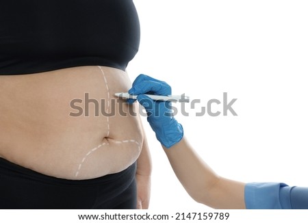 Doctor drawing marks on obese woman's body against white background, closeup. Weight loss surgery Royalty-Free Stock Photo #2147159789