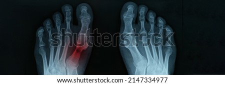 X ray of feet with tarsal fracture closeup Royalty-Free Stock Photo #2147334977