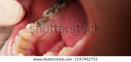 Decayed tooth root canal treatment. Tooth or teeth decay of lower molar. Restoration with a composite filling. Adult caries. bad teeth. Dental temporary restorative material. Dental concept. close up. Royalty-Free Stock Photo #2147462755