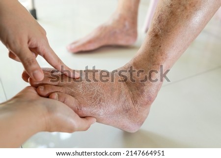 Hands of doctor or nurse examining the dry,cracked,swollen feet of old elderly people,skin care problems,senior woman with diabetes or kidney disease causing swollen legs,health care,medical concept Royalty-Free Stock Photo #2147664951