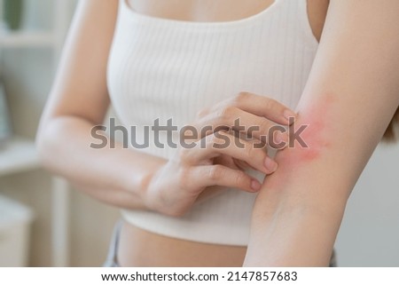 Dermatology asian young woman, girl allergy, allergic reaction from atopic, insect bites on her arm, hand in scratching itchy, itch red spot or rash of skin. Healthcare, treatment of beauty. Royalty-Free Stock Photo #2147857683