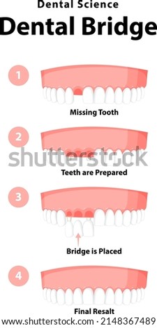 Infographic of human in dental bridge on white background illustration