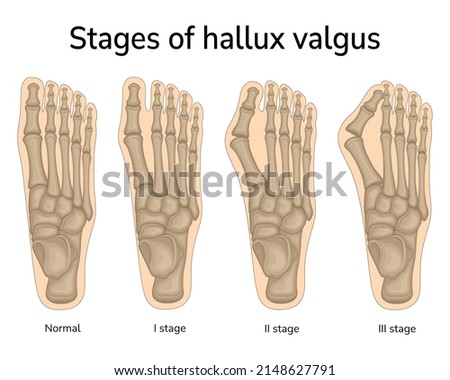 Three stages of valgus deformity of the big toe Royalty-Free Stock Photo #2148627791