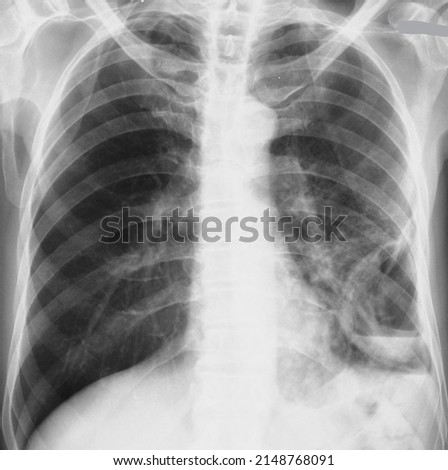 AIR-IN-LUNG-CAVITY Stock Photos and Images - Avopix.com