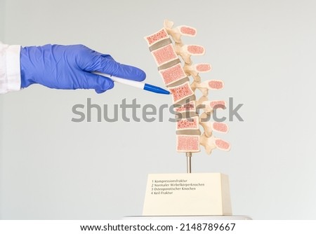 The doctor shows a model of the human spine, which shows various defects in the vertebrae. Inscriptions on the model: 1-Compression fracture, 2-Normal vertebral, 3-Osteoporotic bone, 4-Wedge fracture. Royalty-Free Stock Photo #2148789667