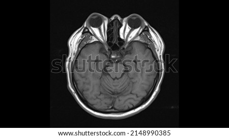 normal  brain anatomy axial t1weighted  MRI images Royalty-Free Stock Photo #2148990385