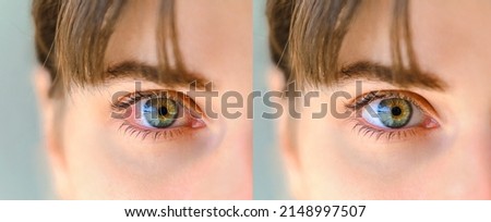 Red eye before and after treatment. Tired eyes and contact lenses. Close up. Dry eye before and after the use of eye drop. Royalty-Free Stock Photo #2148997507