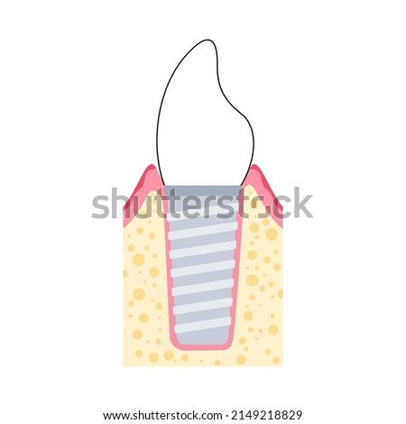 Dental implants surgery concept. Anatomical poster with human teeth. Prosthesis in mouth. Crown abutment and screw medical poster isolated flat vector illustration for clinic or education. .