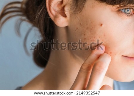 Woman with red cheeks- diathesis or allergy symptoms. Redness and peeling of the skin on the face. Teenage girl with acne problem on beige background, closeup. Royalty-Free Stock Photo #2149352547