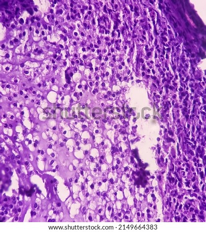 Fibroepithelial polyp of tongue, show fibrocollagenous tissue lined by stratified squamous epithelium, no malignancy, Tongue polyp. Royalty-Free Stock Photo #2149664383