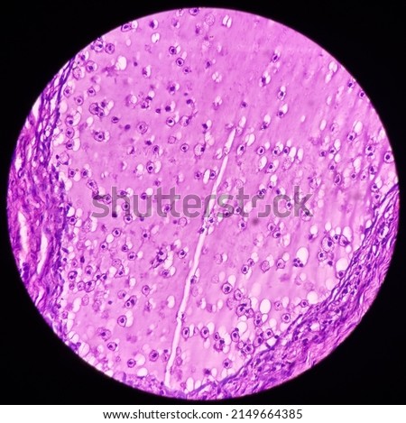 Fibroepithelial polyp of tongue, show fibrocollagenous tissue lined by stratified squamous epithelium, no malignancy, Tongue polyp. Royalty-Free Stock Photo #2149664385