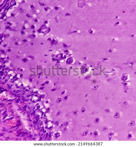 Fibroepithelial polyp of tongue, show fibrocollagenous tissue lined by stratified squamous epithelium, no malignancy, Tongue polyp. Royalty-Free Stock Photo #2149664387