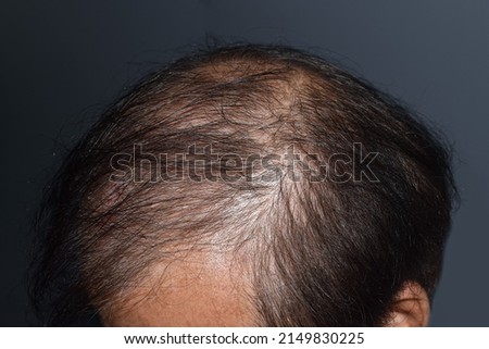 Thinning or sparse hair, male pattern hair loss in Southeast Asian, Chinese elder man. Royalty-Free Stock Photo #2149830225