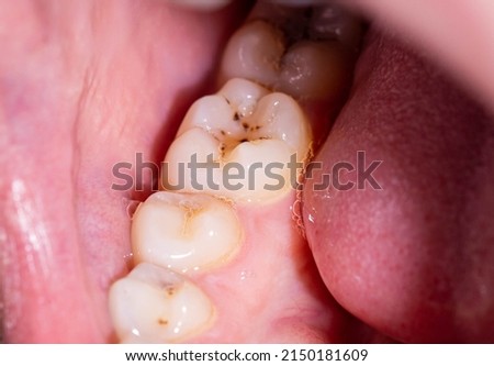 Caries in the mouth on the chewing teeth. Installation of high quality dental fillings. Dental treatment in modern dentistry Royalty-Free Stock Photo #2150181609