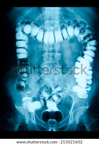 picture of intestinal abdominal xray