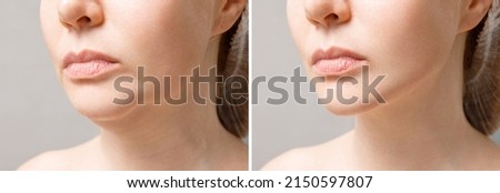 Female double chin before and after correction. Correction of the chin shape liposuction of the neck. The result of the procedure in the clinic of aesthetic medicine. Royalty-Free Stock Photo #2150597807