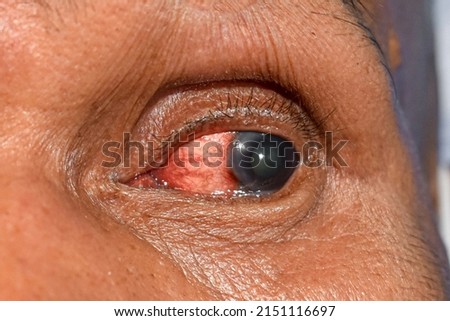 Corneal infection or ulcer called keratitis in Asian old woman. Royalty-Free Stock Photo #2151116697