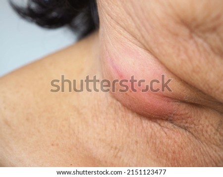 Lymph nodes swollen, lymphoma  or inflamed lymph nodes, closeup view of an adult with sore throat or pain on the neck. health concept. Royalty-Free Stock Photo #2151123477