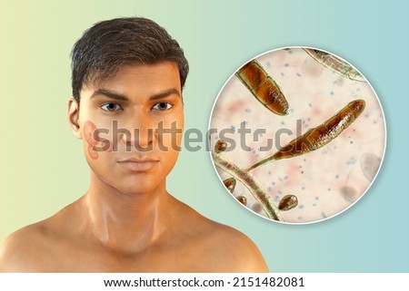 Fungal infection on a man's face, 3D illustration of a man with Tinea faciei and close-up view of fungi Trichophyton rubrum