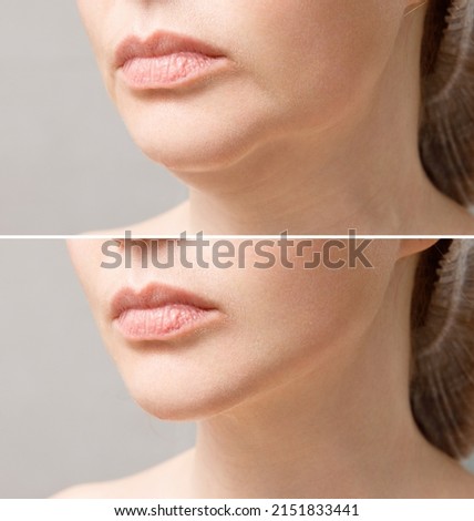 Female double chin before and after correction. Correction of the chin shape liposuction of the neck. The result of the procedure in the clinic of aesthetic medicine. Royalty-Free Stock Photo #2151833441