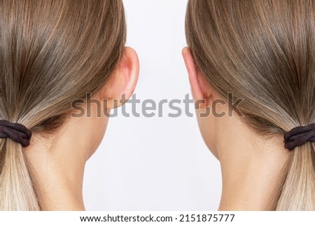 Cropped shot of woman's head with ears before and after otoplasty isolated on a white background. Result of cosmetic plastic surgery of correction auricles and getting rid of lop - eared Royalty-Free Stock Photo #2151875777