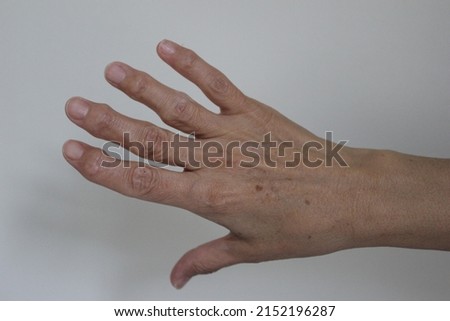 old woman hands with rheumatoid arthritis