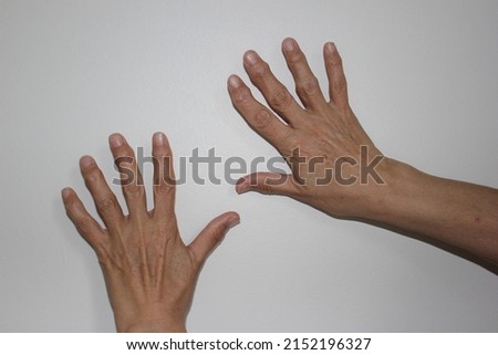 old woman hands with rheumatoid arthritis