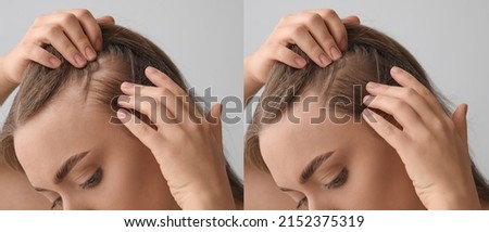 Woman before and after hair loss treatment on grey background, closeup Royalty-Free Stock Photo #2152375319